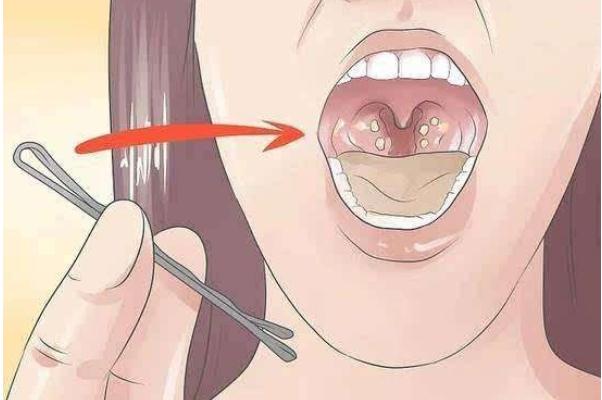 扁桃體發(fā)炎有膿點(diǎn)嚴(yán)重嗎 扁桃體發(fā)炎有遺傳性嗎 扁桃體發(fā)炎有膿點(diǎn)嚴(yán)重嗎 扁桃體發(fā)炎有遺傳性嗎