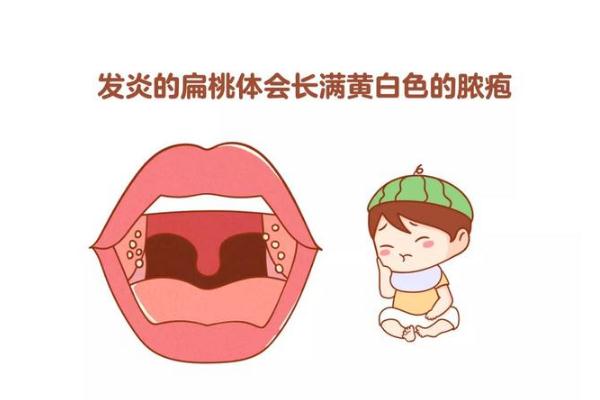 扁桃體發(fā)炎怎么辦最有效的方法 扁桃體發(fā)炎是怎么引起的 扁桃體發(fā)炎怎么辦最有效的方法 扁桃體發(fā)炎是怎么引起的