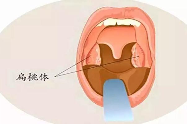 扁桃體發(fā)炎怎么辦最有效的方法 扁桃體發(fā)炎是怎么引起的 扁桃體發(fā)炎怎么辦最有效的方法 扁桃體發(fā)炎是怎么引起的