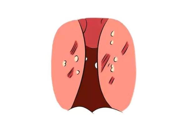 扁桃體發(fā)炎有膿點(diǎn)嚴(yán)重嗎 扁桃體發(fā)炎有遺傳性嗎 扁桃體發(fā)炎有膿點(diǎn)嚴(yán)重嗎 扁桃體發(fā)炎有遺傳性嗎