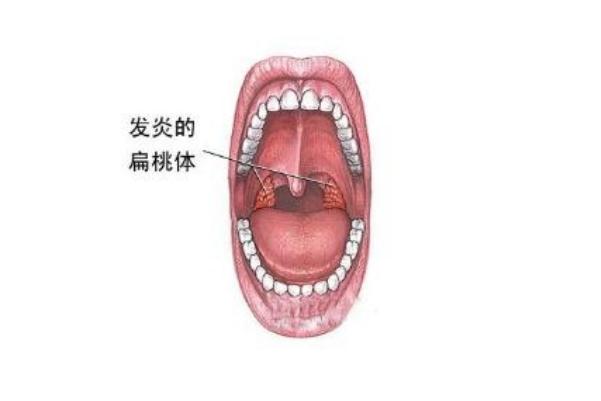 扁桃體發(fā)炎怎么辦最有效的方法 扁桃體發(fā)炎是怎么引起的 扁桃體發(fā)炎怎么辦最有效的方法 扁桃體發(fā)炎是怎么引起的