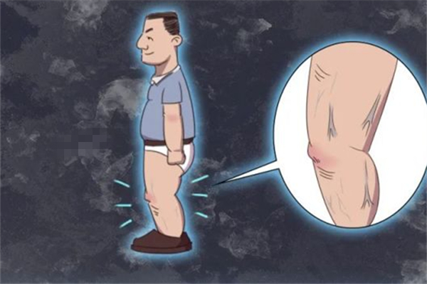 靜脈曲張會自己消失嗎 靜脈曲張嚴(yán)重的后果會怎樣 靜脈曲張會自己消失嗎 靜脈曲張嚴(yán)重的后果會怎樣