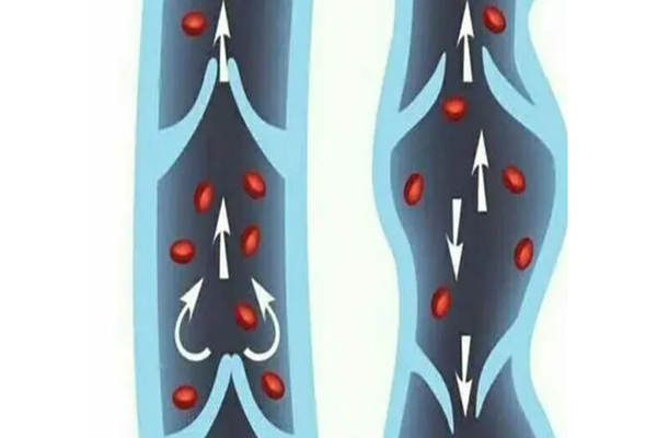 靜脈曲張會自己消失嗎 靜脈曲張嚴(yán)重的后果會怎樣 靜脈曲張會自己消失嗎 靜脈曲張嚴(yán)重的后果會怎樣