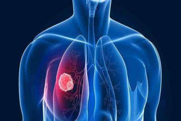 肺結(jié)核會導(dǎo)致不孕不育嗎 肺結(jié)核會導(dǎo)致輸卵管堵塞嗎 肺結(jié)核會導(dǎo)致不孕不育嗎 肺結(jié)核會導(dǎo)致輸卵管堵塞嗎