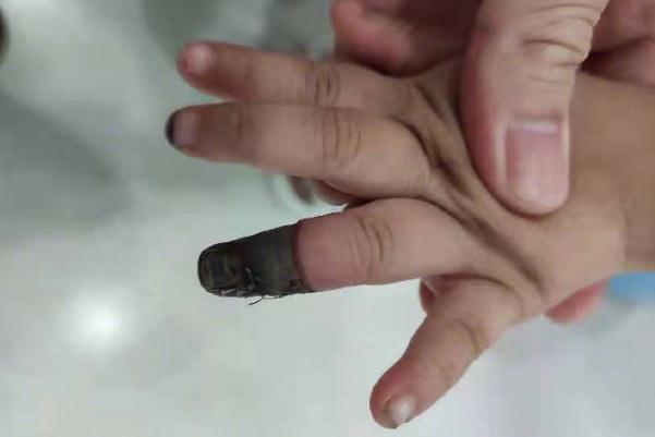 家人錯(cuò)誤包扎致3歲女童手指壞死 傷口如何正確包扎 家人錯(cuò)誤包扎致3歲女童手指壞死 傷口如何正確包扎