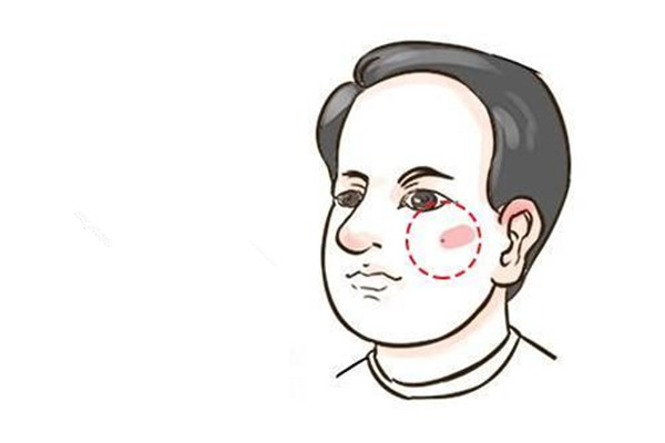 點痣有什么忌口 點痣有什么講究 點痣有什么忌口 點痣有什么講究