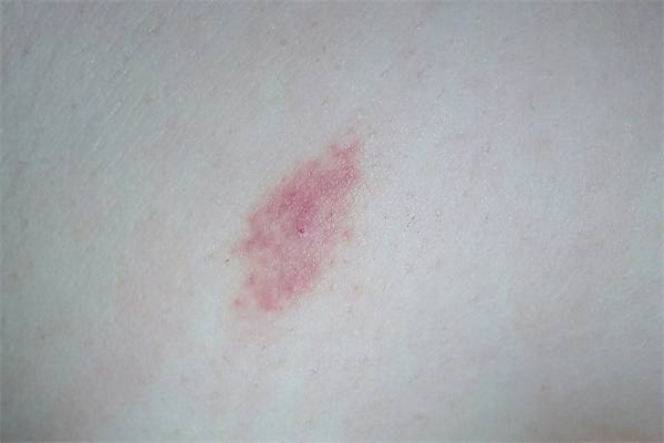 吸草莓出血怎么回事 吸草莓可以吸哪些部位 吸草莓出血怎么回事 吸草莓可以吸哪些部位