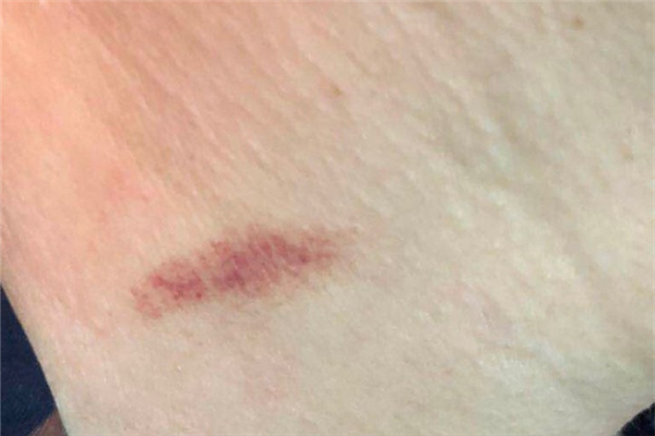 吸草莓出血怎么回事 吸草莓可以吸哪些部位 吸草莓出血怎么回事 吸草莓可以吸哪些部位