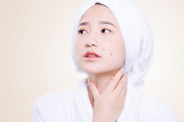 刷酸爆痘之后怎么辦 刷酸可以祛痘印嗎 刷酸爆痘之后怎么辦 刷酸可以祛痘印嗎