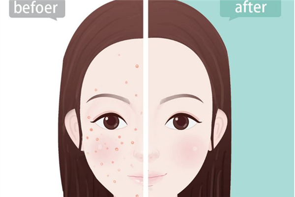 果酸換膚多少錢 果酸換膚的功效和作用 果酸換膚多少錢 果酸換膚的功效和作用