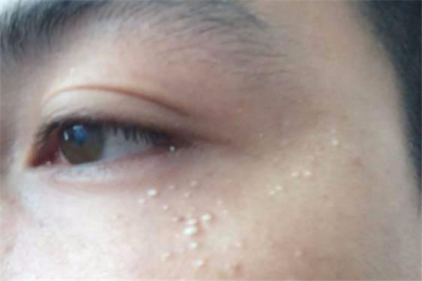 脂肪粒去醫(yī)院去除需要多少錢 脂肪粒去醫(yī)院去除還是去美容院去除 脂肪粒去醫(yī)院去除需要多少錢 脂肪粒去醫(yī)院去除還是去美容院去除