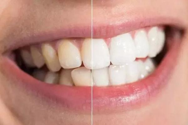 牙黃怎么變白簡單方法 牙黃是什么原因導致的 牙黃怎么變白簡單方法 牙黃是什么原因導致的