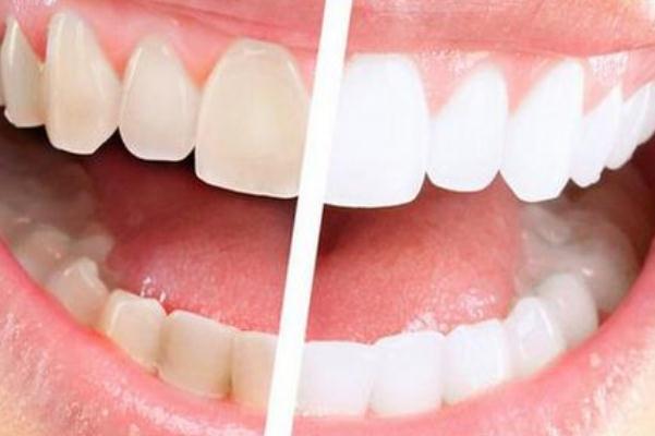 牙黃會(huì)口臭嗎 牙黃可以洗白嗎 牙黃會(huì)口臭嗎 牙黃可以洗白嗎