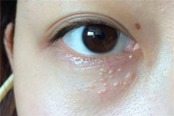 ?脂肪粒去除了還會(huì)長(zhǎng)嗎 脂肪粒怎么預(yù)防 ?脂肪粒去除了還會(huì)長(zhǎng)嗎 脂肪粒怎么預(yù)防