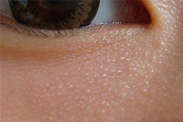 脂肪粒摳掉了留疤了怎么辦 脂肪粒怎么消除在眼部周圍的 脂肪粒摳掉了留疤了怎么辦 脂肪粒怎么消除在眼部周圍的