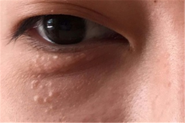 脂肪粒去醫(yī)院去除需要多少錢 脂肪粒去醫(yī)院去除還是去美容院去除 脂肪粒去醫(yī)院去除需要多少錢 脂肪粒去醫(yī)院去除還是去美容院去除