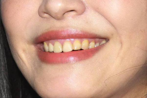 牙黃怎么變白簡單方法 牙黃是什么原因導致的 牙黃怎么變白簡單方法 牙黃是什么原因導致的