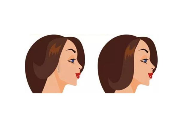 削骨瘦臉風險大嗎 削骨瘦臉多久可以恢復 削骨瘦臉風險大嗎 削骨瘦臉多久可以恢復