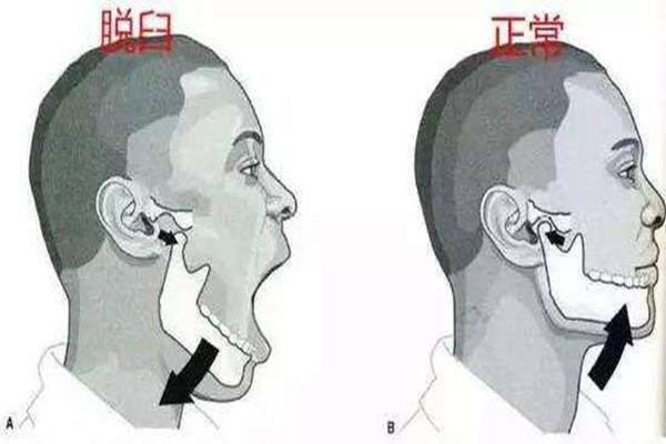 下巴脫臼怎么回事 下巴脫臼掛哪個(gè)科 下巴脫臼怎么回事 下巴脫臼掛哪個(gè)科