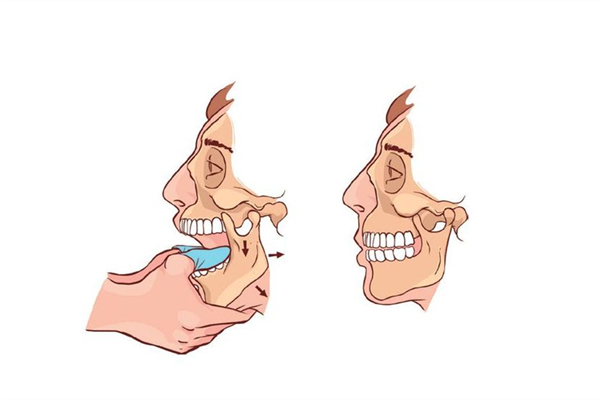 下巴脫臼怎么回事 下巴脫臼掛哪個(gè)科 下巴脫臼怎么回事 下巴脫臼掛哪個(gè)科