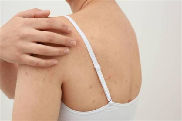 雞皮膚激光可以根治嗎 雞皮膚激光治療多少錢 雞皮膚激光可以根治嗎 雞皮膚激光治療多少錢