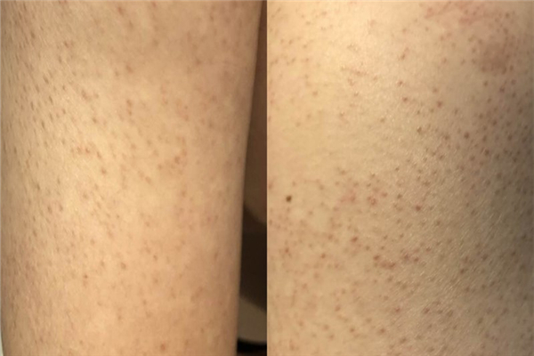 雞皮膚要補(bǔ)充什么維生素 雞皮膚吃什么能改善 雞皮膚要補(bǔ)充什么維生素 雞皮膚吃什么能改善