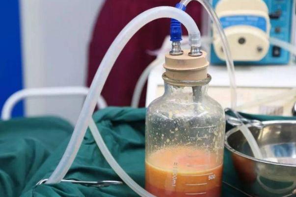 抽脂肪對身體有什么副作用 抽脂手術大概花多少錢 抽脂肪對身體有什么副作用 抽脂手術大概花多少錢