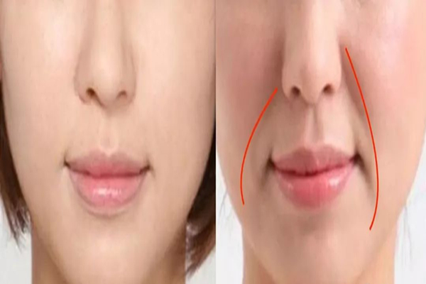 法令紋去除的最好方法 法令紋是怎么產(chǎn)生的 法令紋去除的最好方法 法令紋是怎么產(chǎn)生的