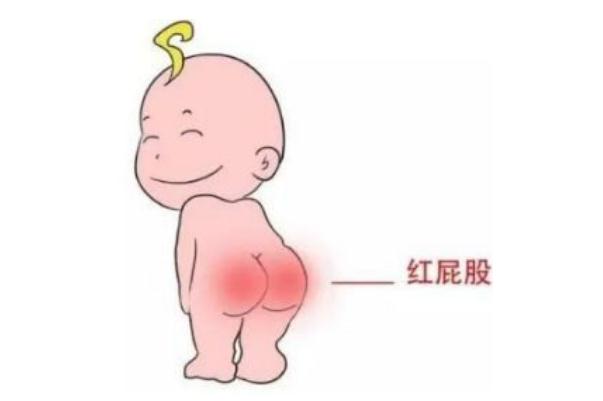 寶寶紅屁股會(huì)疼嗎 寶寶紅屁股會(huì)影響什么 寶寶紅屁股會(huì)疼嗎 寶寶紅屁股會(huì)影響什么