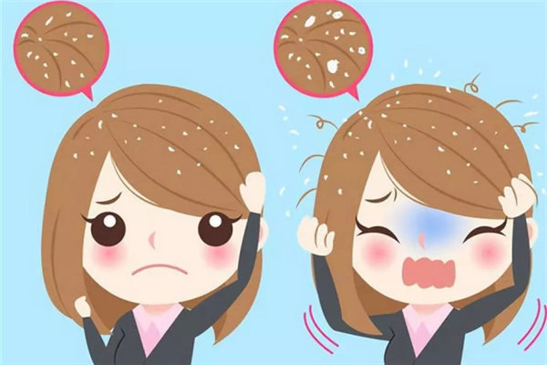 頭屑很多大塊是什么原因 大塊頭皮屑怎么治 頭屑很多大塊是什么原因 大塊頭皮屑怎么治