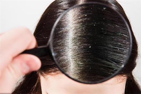 頭屑是因?yàn)轭^皮干燥嗎 頭屑是缺什么維生素 頭屑是因?yàn)轭^皮干燥嗎 頭屑是缺什么維生素