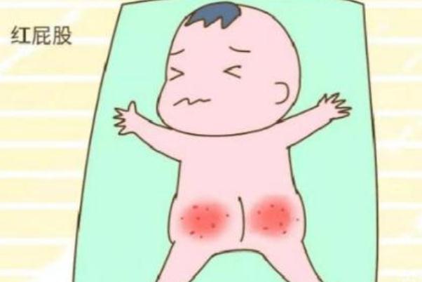 寶寶紅屁股是不是尿不濕造成 寶寶紅屁股是過(guò)敏癥狀嗎 寶寶紅屁股是不是尿不濕造成 寶寶紅屁股是過(guò)敏癥狀嗎