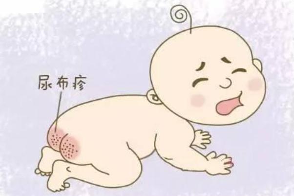 寶寶紅屁股擦什么好得快 寶寶紅屁股破了怎么處理 寶寶紅屁股擦什么好得快 寶寶紅屁股破了怎么處理