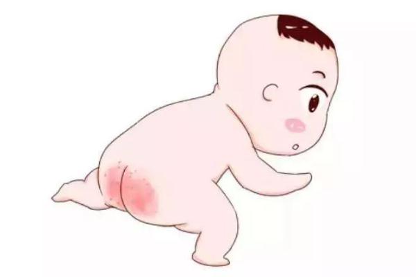 寶寶紅屁股是不是尿不濕造成 寶寶紅屁股是過(guò)敏癥狀嗎 寶寶紅屁股是不是尿不濕造成 寶寶紅屁股是過(guò)敏癥狀嗎