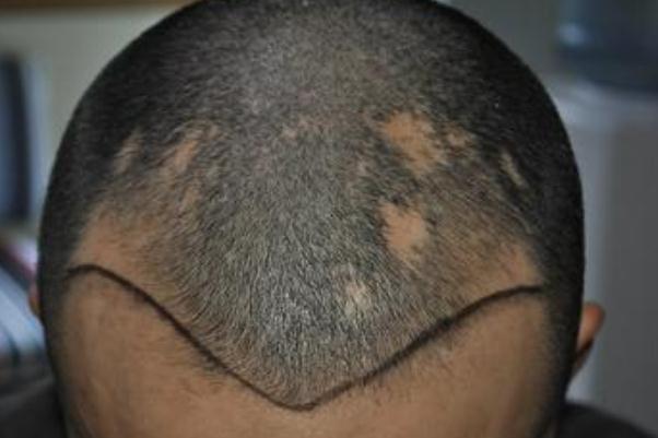 植發(fā)是永久性的嗎 植發(fā)是拆東墻補(bǔ)西墻嗎 植發(fā)是永久性的嗎 植發(fā)是拆東墻補(bǔ)西墻嗎