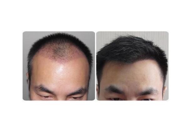 植發(fā)要多少錢一般 植發(fā)可以維持多久 植發(fā)要多少錢一般 植發(fā)可以維持多久