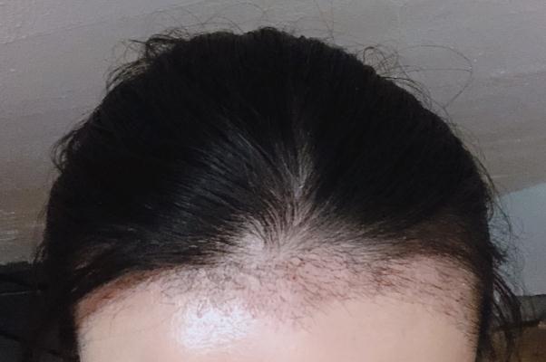 植發(fā)可以用別人的毛囊嗎 植發(fā)可以保持多久時(shí)間 植發(fā)可以用別人的毛囊嗎 植發(fā)可以保持多久時(shí)間