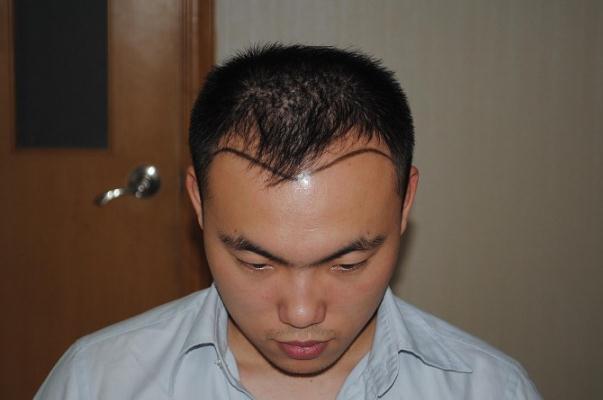 植發(fā)可以用別人的毛囊嗎 植發(fā)可以保持多久時(shí)間 植發(fā)可以用別人的毛囊嗎 植發(fā)可以保持多久時(shí)間