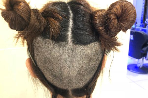 植發(fā)是永久性的嗎 植發(fā)是拆東墻補(bǔ)西墻嗎 植發(fā)是永久性的嗎 植發(fā)是拆東墻補(bǔ)西墻嗎