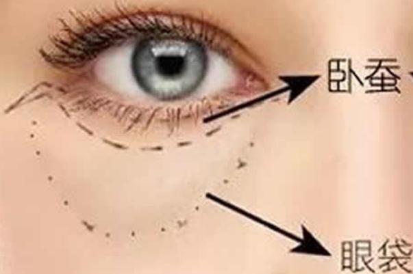 眼袋是脾虛引起的嗎 眼袋是哪個經(jīng)絡(luò)堵塞 眼袋是脾虛引起的嗎 眼袋是哪個經(jīng)絡(luò)堵塞