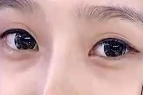 眼袋是脾虛引起的嗎 眼袋是哪個經(jīng)絡(luò)堵塞 眼袋是脾虛引起的嗎 眼袋是哪個經(jīng)絡(luò)堵塞