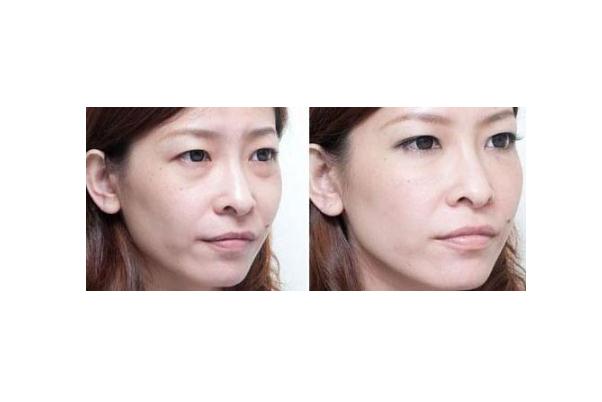 眼袋有細紋了怎么消除 眼袋上有細紋怎么解決 眼袋有細紋了怎么消除 眼袋上有細紋怎么解決