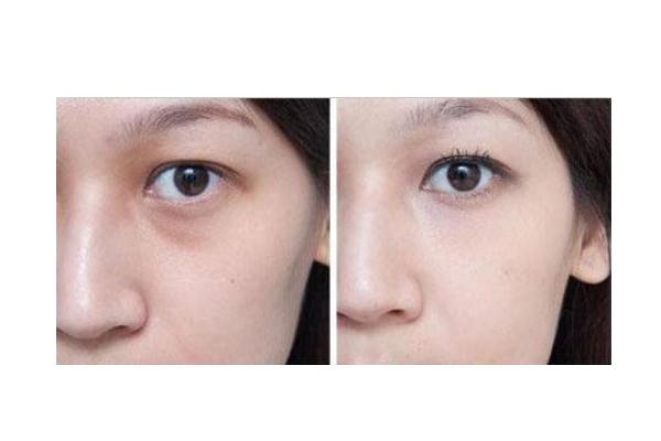 眼袋可以針灸治療嗎 眼袋可以按摩去除嗎 眼袋可以針灸治療嗎 眼袋可以按摩去除嗎