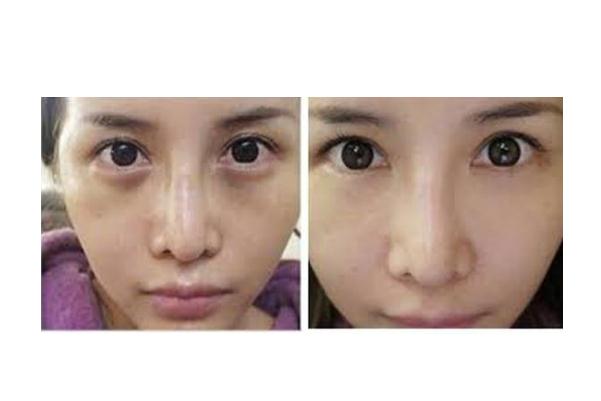 眼袋可以切幾次 眼袋可以通過手術(shù)徹底消除嗎 眼袋可以切幾次 眼袋可以通過手術(shù)徹底消除嗎