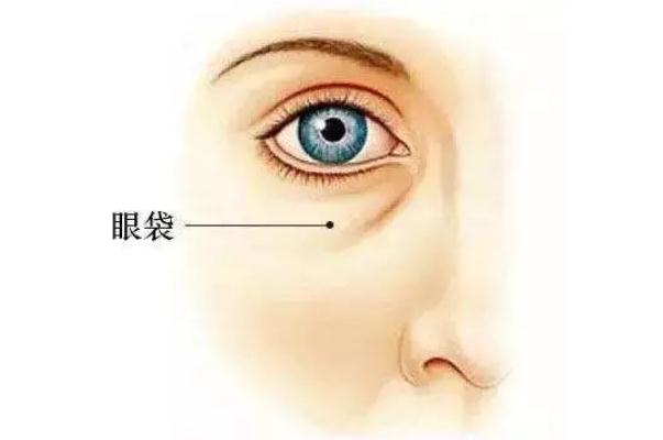 眼袋腫了怎么辦才能消腫 眼袋浮腫怎么回事 眼袋腫了怎么辦才能消腫 眼袋浮腫怎么回事