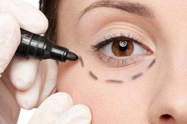 眼袋會不會遺傳 眼袋能自然消除嗎 眼袋會不會遺傳 眼袋能自然消除嗎