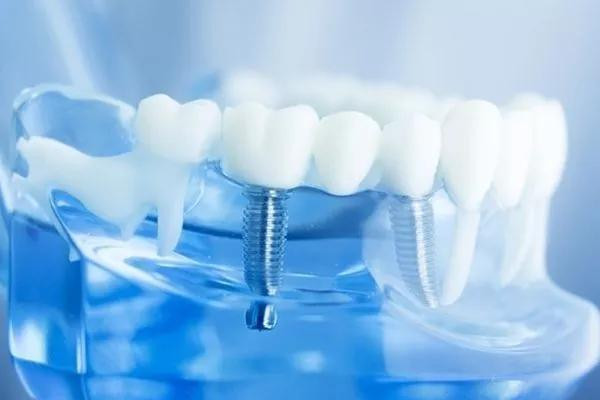 種植牙后多久能吃東西 種植牙后怎么刷牙 種植牙后多久能吃東西 種植牙后怎么刷牙