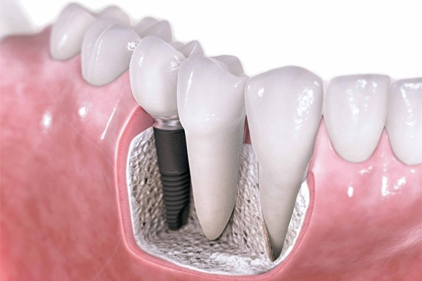 種植牙后多久能吃東西 種植牙后怎么刷牙 種植牙后多久能吃東西 種植牙后怎么刷牙