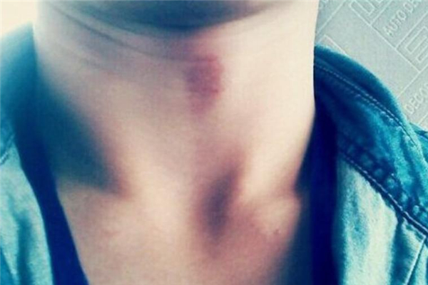 吻痕用雞蛋熱敷管用嗎 吻痕用雞蛋敷過后什么時候能消 吻痕用雞蛋熱敷管用嗎 吻痕用雞蛋敷過后什么時候能消