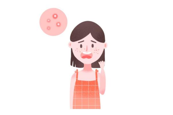 粉刺要不要擠出來(lái) 粉刺要怎么處理 粉刺要不要擠出來(lái) 粉刺要怎么處理